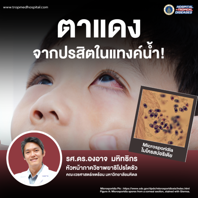 อาการตาแดง จากการติดเชื้อปรสิตจากน้ำ